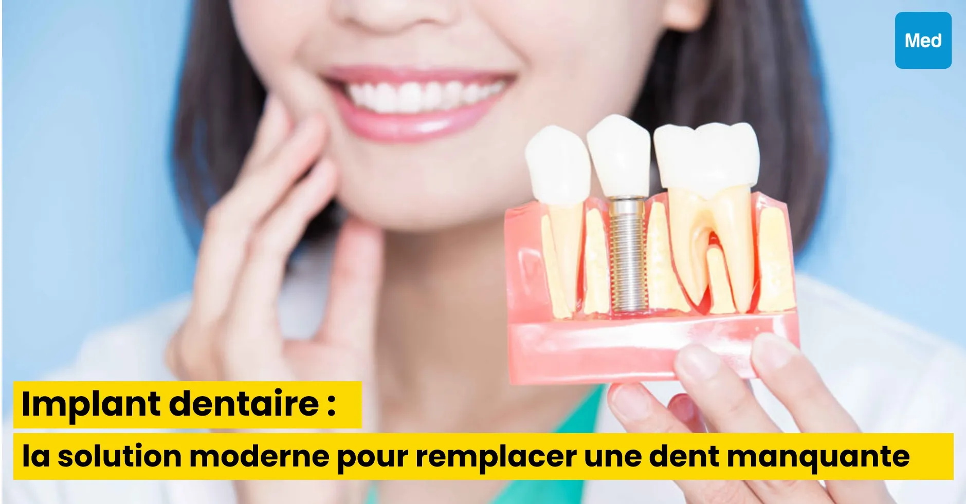 Implant dentaire : la solution moderne pour remplacer une dent manquante
